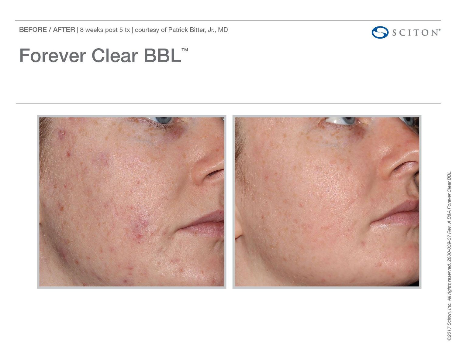 Before and after Forever Clear BBL acne treatment